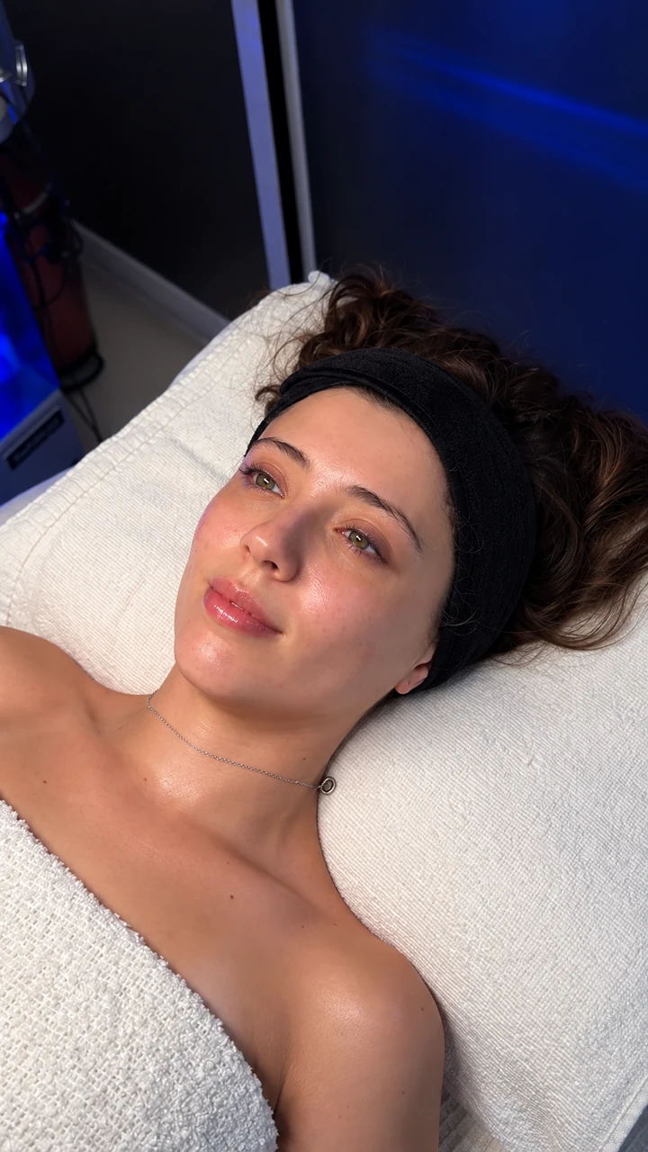 Fotografía 03 compartida como después de una sesión de Hydrafacial